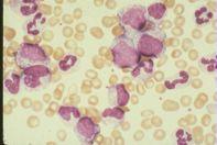 CML - chronic phase WBC increased Entire granulocytic spectrum on blood film Marrow hyperplasia expanded myeloid series eo and basophil precursors megakaryocytes Low neutrophil alkaline phosphatase