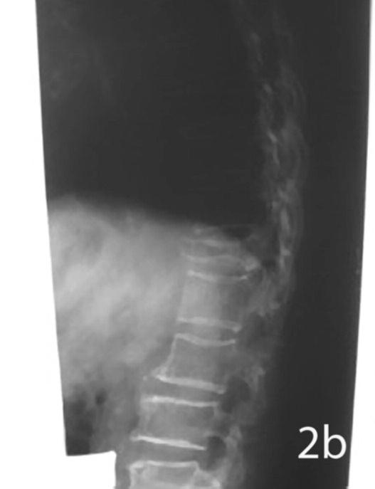 Bone graft itself has the same Young s modulus rather than polymethylmetacrylate (PMMA), thus the risk of fracture at the vertebrae above and below the