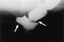 DIAGNOSIS OF DEFECATORY DYSFUNCTION Rectocele Intussusception and colonoscopy. Moreover, currently available physiological tests do not completely evaluate anorectal function.