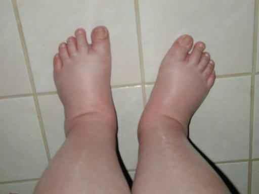 Fluid filled feet (Photo by http://www.thegeminigeek.com/what-causes-swollen-feet) Another cause of the accumulation of fluid in the feet and ankles is correlated to the kidneys and blood flow.