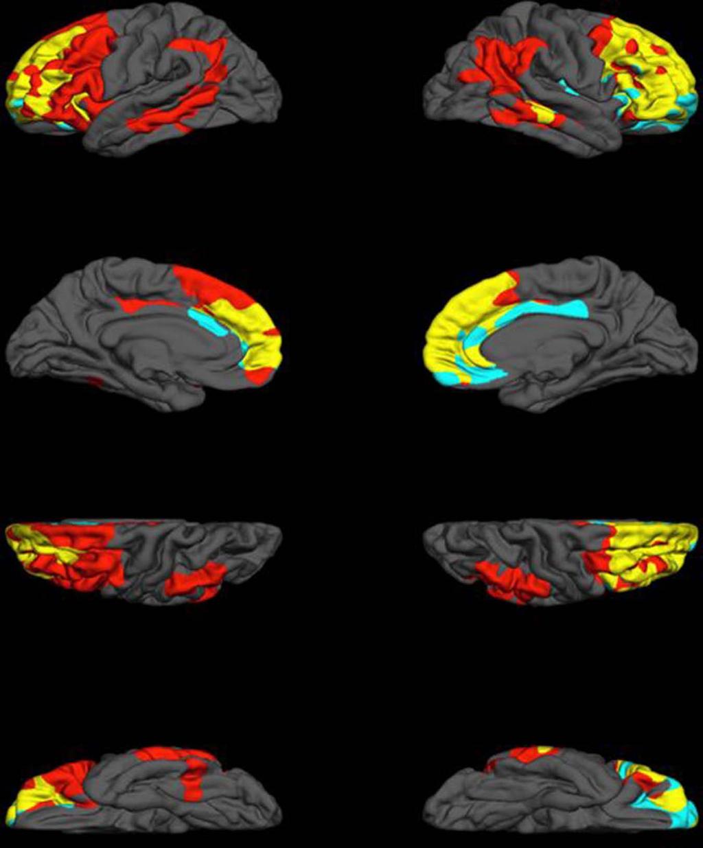 regions unique to either, as well as regions of overlap (Figure 2). Note that deficits on EF tests can occur with atrophy to parietal regions as well as classical frontal ones.