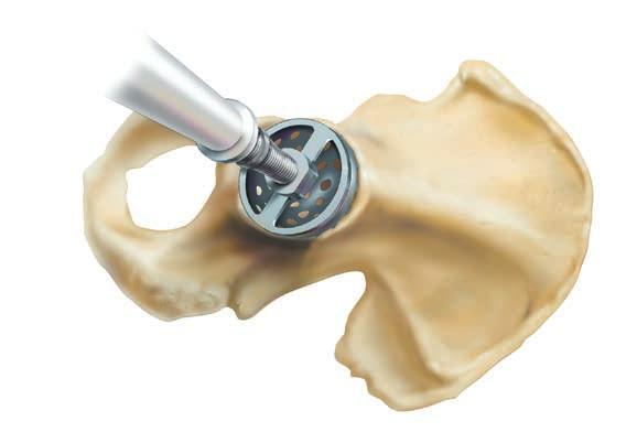Approach to the Acetabulum Use the approach with which you are most familiar to achieve the best surgical results.