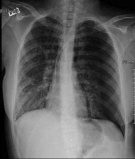 sudden onset of left sided chest pain following a coughing spasm.