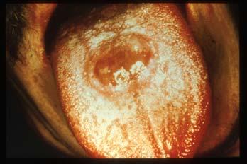 lesions occur several weeks after the primary chancre appears; and may persist for weeks to months.