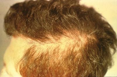 Secondary Syphilis Alopecia Latent Syphilis Host suppresses infection, but no lesions are clinically apparent Only evidence is a positive serologic test May occur between primary and secondary