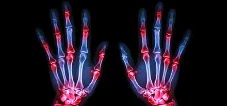I N F E C T I O U S D I S E A S E S Rheumatoid arthritis Rheumatoid arthritis (RA) is a common systemic autoimmune disease affecting up to 2% of the general population.