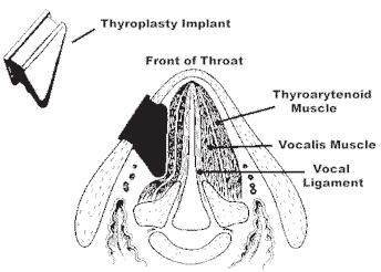 Summer Spring 2008 2007 Understanding Thyroplasty A thyroplasty is a procedure performed to help correct vocal cord weakness.