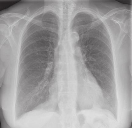 Chest radiography in patients