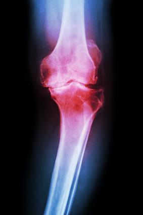 Treatment Methods Diagnosis: Before you get treatment for osteoarthritis, it is important for you to diagnose the condition.