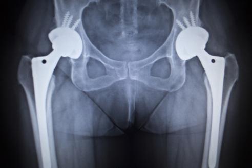 Joint Replacement: The surgeon removes damaged joint surfaces and replaces them with plastic and metal parts in joint replacement surgery.