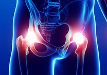Hip Dislocation: When the ball comes free from the socket, this is called dislocation of the hip replacement. Generally, this occurs after a fall. However, there are other things that could cause it.