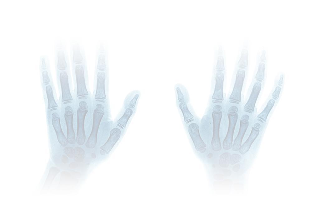 Present in about 75% to 80% of Rheumatoid arthritis patients, Rheumatoid factor (RF) indicates the severity of the disease.
