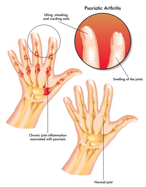 Signs and Symptoms Early signs of Psoriatic Arthritis Psoriatic arthritis can either develop quickly and be severe, or can develop slowly with mild symptoms.
