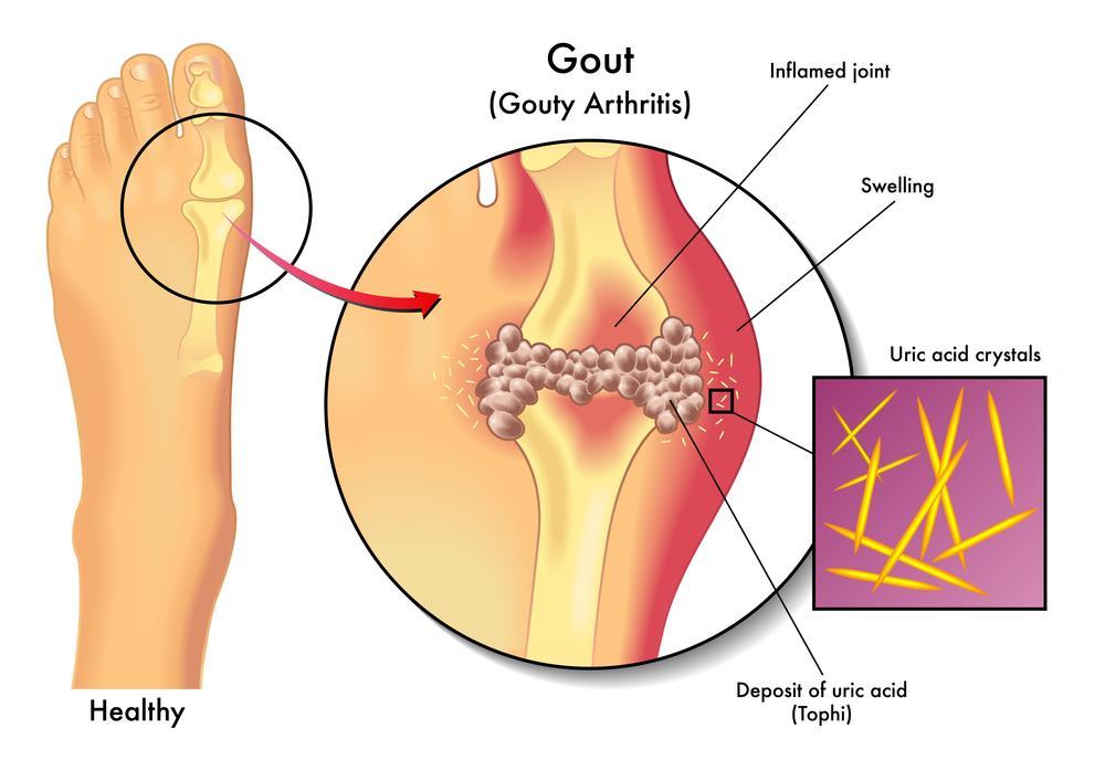 Gout Apart from osteoarthritis, Rheumatoid arthritis, and psoriatic arthritis, another common form of arthritis is gout.
