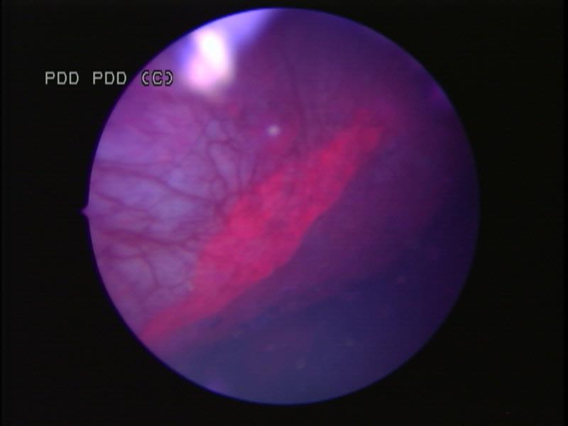 Photodynamic Diagnostic Cystoscopy PDD exploits the photoactive properties of compounds such as hexaminolevulinate (HAL) (Hexvix TM, Cysview TM ).