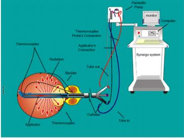 Hyperthermia Systems Synergo Intravesical microwave applicator 5