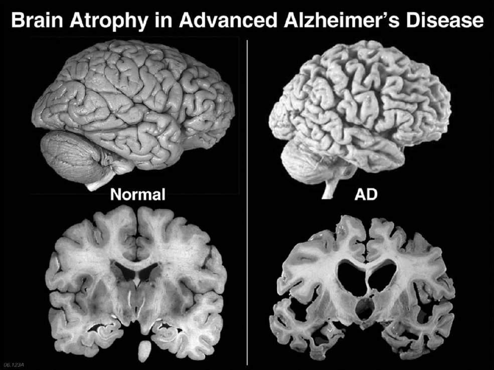 Stanford University Study Points to Endocannabinoid Deficiency as Cause of Alzheimer s A new study led by investigators at the Stanford University School of Medicine has implicated the