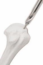 9. Long Nail Selection For entry point preparation refer to steps described in previous section 5. The Long Humeral Nail is available in 7, 8 and 9mm diameter and 20, 22.5, 25, 27.