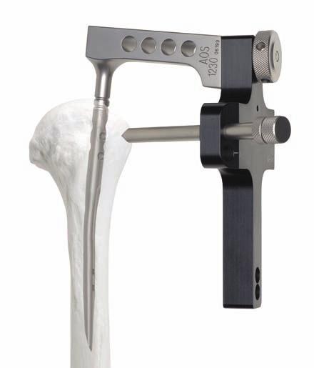 Aggressiveness can result in additional fractures or fragment displacements. If the nail does not advance easily, use the image intensifier to identify the problem.