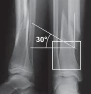 Fig 7 Example of a supracondylar fracture (a) and a tibia shaft fracture (b). Stable fractures Type I In a strict lateral view the Rogers line still intersects the capitellum.