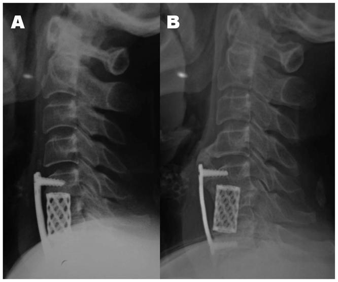 Figure 1. A 52-year-old female who underwent 1-level corpectomy and TMC fusion. 2A.