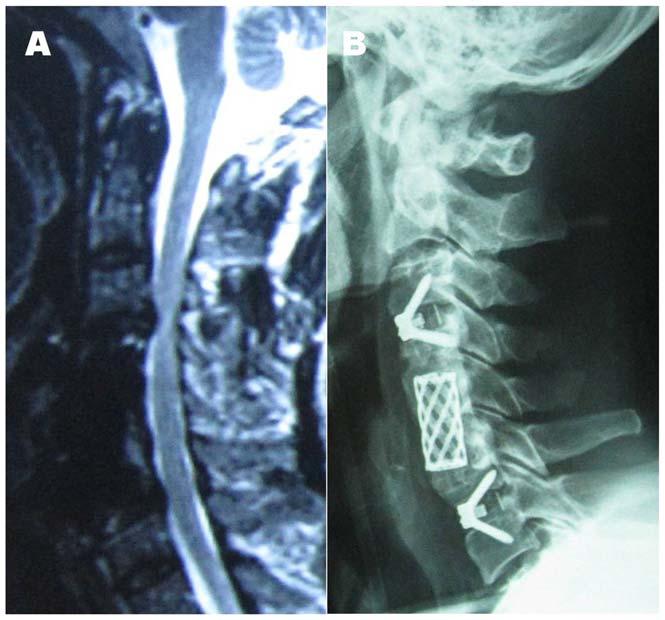 Figure 2. A 58-year-old male who received a reoperation for symptomatic adjacent segment disease. 1A.