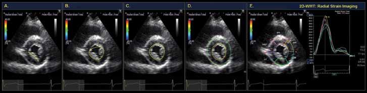 2 Advanced Multi-layer Speckle Strain: Clinical Case Examples Advanced Multi-layer Speckle Strain: Clinical Case Examples 3 which the raw data are obtained to strain results from each myocardial