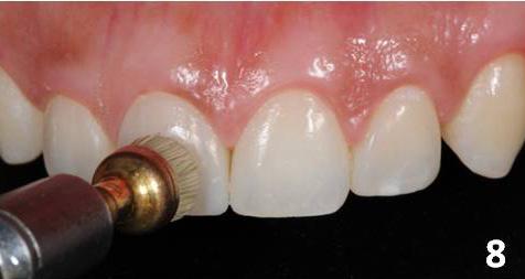 performed with Sof-Lex Pop-On (3M ESPE Dental Figure 3. After performing dental bleaching with 10% hydrogen peroxide and removal of the orthodontic brackets.