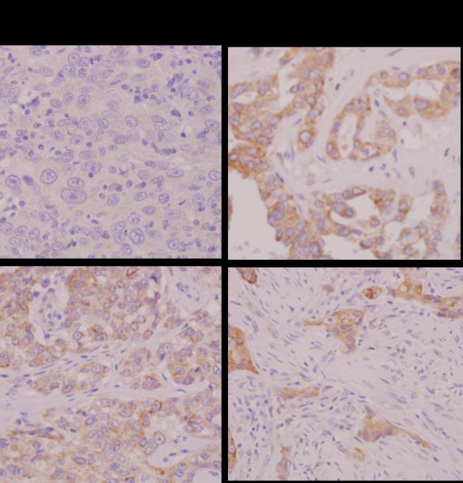 MCL1 amplification occurs at high rates in TNBC and co-occurs with MYC amplification Amplification of the anti-apoptosis gene MCL1 was identified in 56% of tumors. MCL1 IHC p=0.