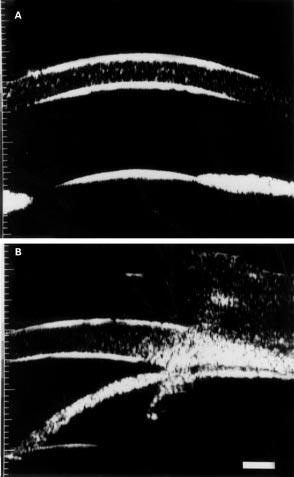 Ultrasound biomicroscopic measurement of anterior chamber angle in premature infants 461 Figure 1 26 g infant who was delivered by caesarean section at 38 weeks gestation.