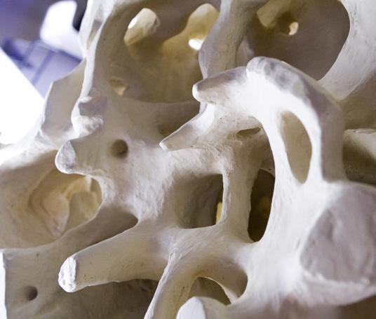 5 Normal bone Osteoporotic bone Figure 1.2: Micrographs of Normal vs. Osteoporotic Bone (Dawson-Hughes, et. al.