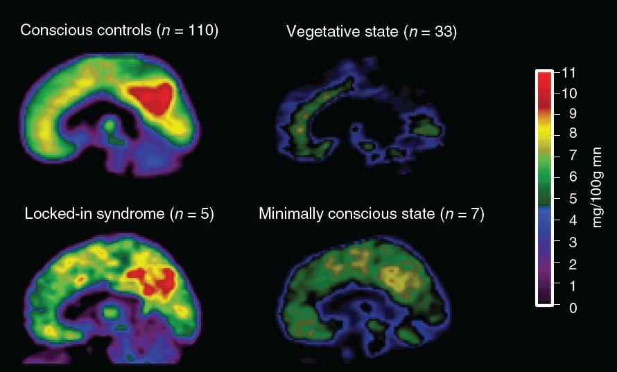 The Neural Basis of Consciousness APPLICATION: Determining Consciousness When It Counts 33 SOURCE: From Brain Function in