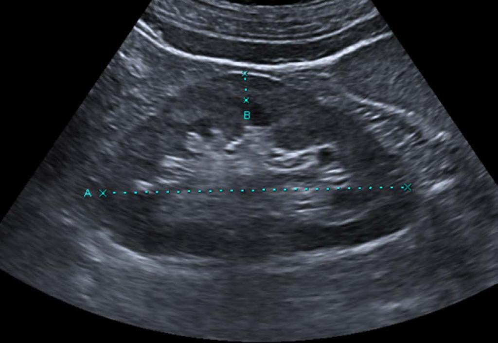 Mehmet Korkmaz, et al. C Fig. 1. representative longitudinal sonogram for the measurement of renal cortical thickness.. Renal length () and cortical thickness () were measured using electric calipers.