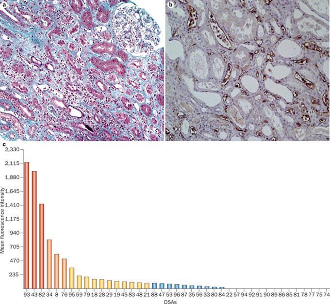 De novo donor-specific HA-antibodies Evidence derived from Histology, 4d-staining and Serology icrovascular inflammation 4d-positive PT staining uminex-based assays also have limitations: - What is