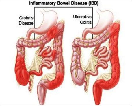 + Inflammatory Bowel Disease n Inflammatory bowel disease (IBD) involves chronic inflammation throughout the GI tract.