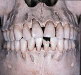 table 1 Characteristics of Thick Gingiva n Relatively flat soft tissue and bony architecture n Dense fibrotic soft tissue n Relatively large amount of attached gingiva n Thick underlying osseous form