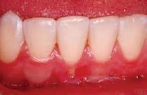 The clinical presentation of thick gingiva and the type of osseous architecture associated with this gingival tissue type. 1b.