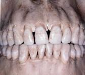 Thin Gingival Biotype Soft tissue: Thin marginal redness and gingival recession Hard tissue: Rapid bone loss associated with soft tissue recession Difficult to predict where tissue will heal and