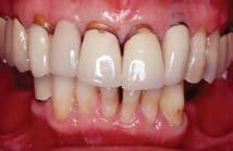 Tissue Biotype in Implant Treatment Planning If osseous and gingival tissues are different for thick and thin tissue biotypes, it seems logical that these distinctions would significantly influence