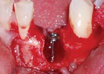 figure 4a. Lower left lateral incisor No. 23 was extracted and extensive bone loss was present.