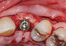 Furthermore, the loss of peri-implant structures may result in thin, transspace, a tenting pin was placed in the socket in an orientation to help support both the facial and vertical dimensions.
