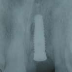 lucent tissue over the implant, which appears grayish, especially if the facial plate is lost and implant threads are exposed.
