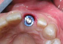 In a thick biotype environment, immediate placement of an implant can be completed with predictable results.