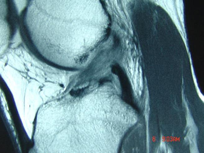 12 M.C. Drakos and R.F. Warren Figure 1 Sagittal MRI of a partially torn ACL with some fibers still in an appropriate orientation and a small bony avulsion of the femoral origin.