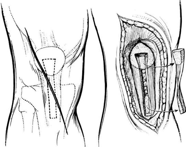 14 M.C. Drakos and R.F. Warren Figure 4 Illustration of the harvest of the central third of the patella tendon (adapted from O Brien et al 13 ).