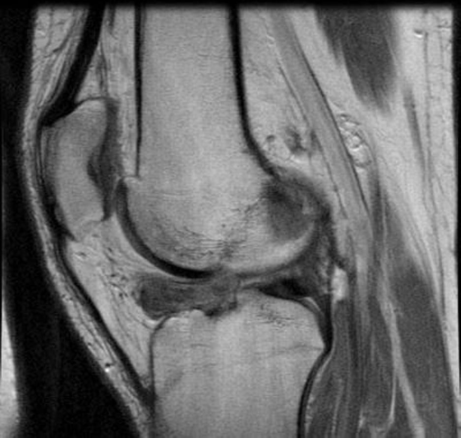 to follow up. Figure 1A. 24-year-old man with ACL tear.