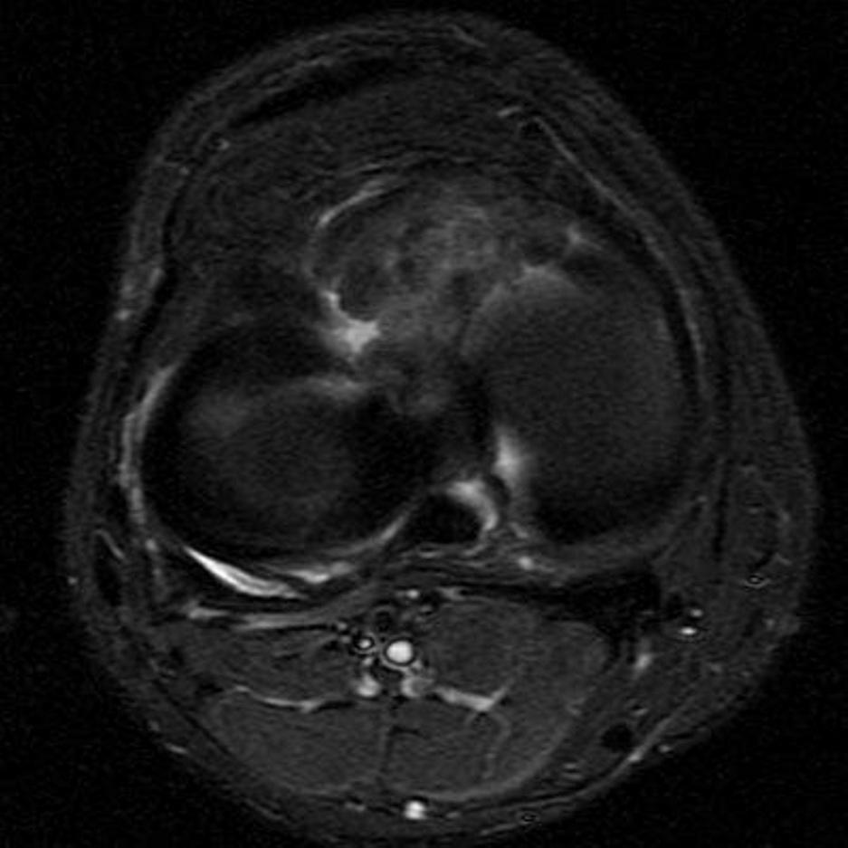 Figure 2. 24-year-old man with ACL tear.