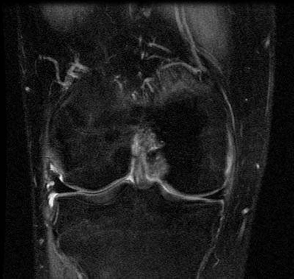 Figure 4. 24-year-old man with ACL tear. Coronal fat-saturated proton density-weighted MRI shows the nodular mass in the intercondylar notch.