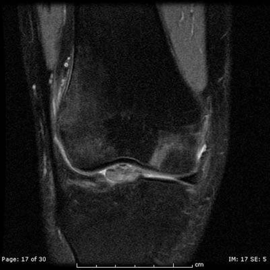 With entrapment, the displaced stump is caught in the intercondylar notch between the lateral femoral condyle and the tibial plateau [1].