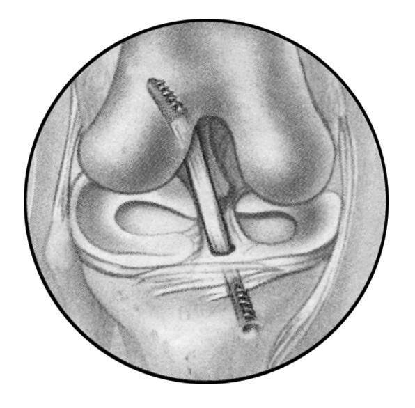 Lateral Collateral Ligament Articular Cartilage Medial Collateral Ligament Attaching the graft What is ACL Surgery?